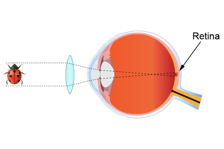 Ray diagram showing how a convex lens used in glasses can correct a hypermetropic eye
